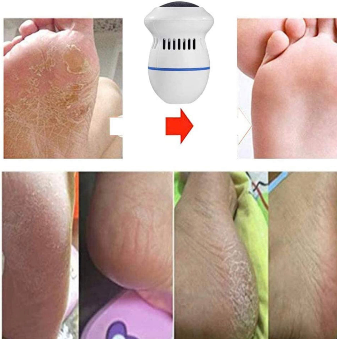 Electric Foot Callus Remover